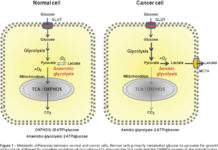 University of Colorado Cancer Center : Cancer hijacks the microbiome to glut itself on glucose