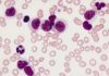 First DNA-based test that allows for predicing risk of leukemia relapse