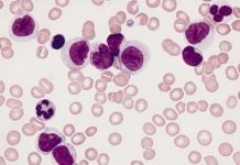 First DNA-based test that allows for predicing risk of leukemia relapse