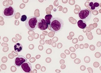 First DNA-based test that allows for predicing risk of leukemia relapse
