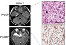 Pediatric brain tumors are characterized by frequent complications due to intractable epilepsy