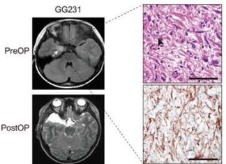 Pediatric brain tumors are characterized by frequent complications due to intractable epilepsy