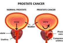 Prostate cancer : Nanoparticle therapeutic restores function of tumor suppressor