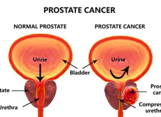 Prostate cancer : Nanoparticle therapeutic restores function of tumor suppressor