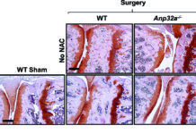 Research : common antioxidant was effective in treating osteoarthritis