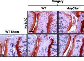 Research : common antioxidant was effective in treating osteoarthritis
