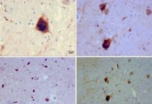 Researcher has moved a step closer to developing a treatment to clear brain cells of a protein that is an integral cause of Parkinson’s disease