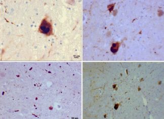 Researcher has moved a step closer to developing a treatment to clear brain cells of a protein that is an integral cause of Parkinson’s disease