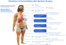 Success of long-term weight loss after bariatric surgery connected to taste preferences