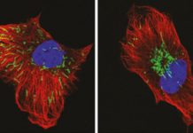 Targeting a pathway that controls the movement of mitochondria could reduce cancer invasiveness and resistance to radiotherapy