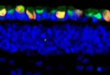 Team identifies developmental stage of retinoblastoma (RB), a tumor of the retina that affects children under five years of age