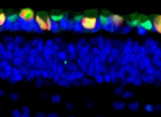 Team identifies developmental stage of retinoblastoma (RB), a tumor of the retina that affects children under five years of age