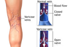 The taller you are, the more likely you are to develop varicose veins