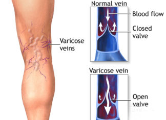 The taller you are, the more likely you are to develop varicose veins
