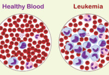 Researchers unraveled the origins and identified mutations associated with a perplexing form of acute leukemia