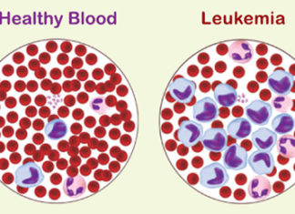 Researchers unraveled the origins and identified mutations associated with a perplexing form of acute leukemia