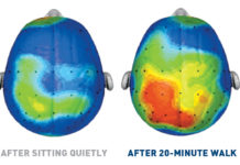 Autosomal dominant Alzheimer’s disease : benefit of physical activity on cognition and dementia progression