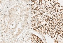 UCLA researchers have discovered genetic similarities between the adult stem cells responsible for maintaining and repairing epithelial tissues and the cells that drive aggressive epithelial cancers