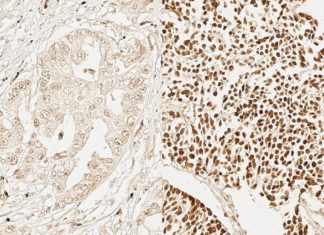 UCLA researchers have discovered genetic similarities between the adult stem cells responsible for maintaining and repairing epithelial tissues and the cells that drive aggressive epithelial cancers
