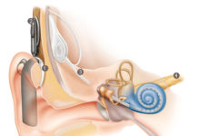 Older adults fitted with a cochlear implant to compensate for severe hearing loss have significantly poorer cognitive function than their normal-hearing counterparts