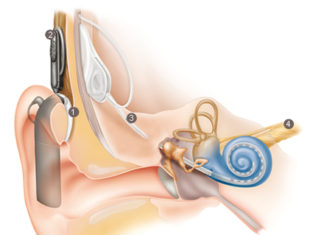 Older adults fitted with a cochlear implant to compensate for severe hearing loss have significantly poorer cognitive function than their normal-hearing counterparts