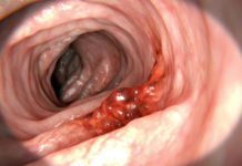 Researchers at Technical University Munich : Colon cancer is caused by bacteria and cell stress