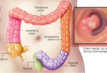 Medial EarlySign adapts financial algorithm modeling for identify patients at high risk of colon cancer