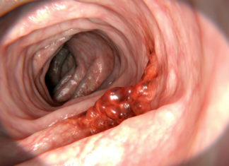 Researchers at Technical University Munich : Colon cancer is caused by bacteria and cell stress