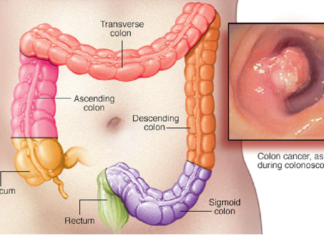 Medial EarlySign adapts financial algorithm modeling for identify patients at high risk of colon cancer
