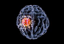 A new clinical trial will test whether an experimental vaccine can help patients’ immune systems to stop the spread of deadly glioblastoma brain cancer