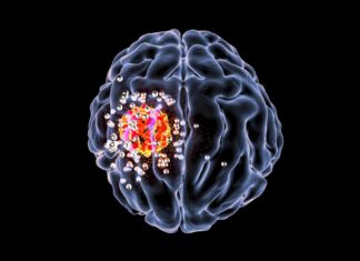A new clinical trial will test whether an experimental vaccine can help patients’ immune systems to stop the spread of deadly glioblastoma brain cancer