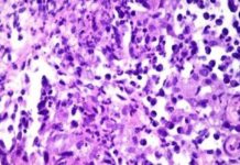The disease, called donovanosis – can destroy genital tissue , was diagnosed in a woman in Southport, England