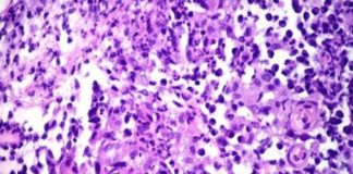 The disease, called donovanosis – can destroy genital tissue , was diagnosed in a woman in Southport, England