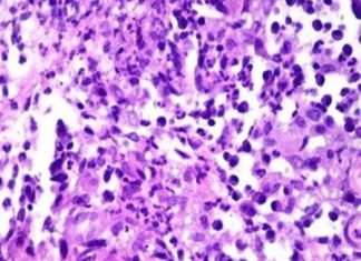 The disease, called donovanosis – can destroy genital tissue , was diagnosed in a woman in Southport, England