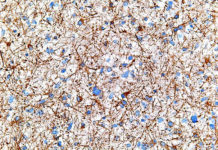 Scientists say a gene involved in the body’s circadian rhythms is a potential target for therapies to help patients with a deadly form of brain cancer known as glioblastoma