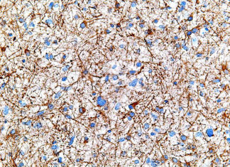 Scientists say a gene involved in the body’s circadian rhythms is a potential target for therapies to help patients with a deadly form of brain cancer known as glioblastoma