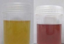 Common antifungal agent might be useful as a treatment for a rare type of porphyria