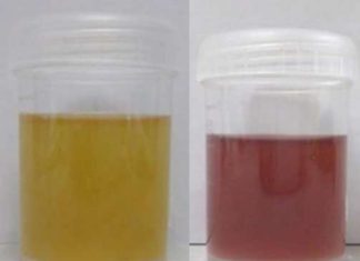 Common antifungal agent might be useful as a treatment for a rare type of porphyria