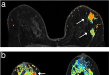 MRI scans twice a year instead of one annual mammogram is far more effective at detecting early breast cancers in young women with a high-risk genetic profile than mammograms alone