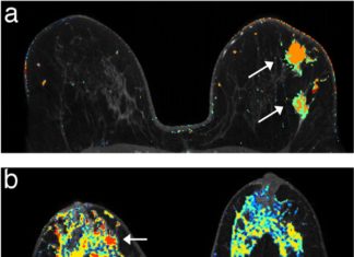 MRI scans twice a year instead of one annual mammogram is far more effective at detecting early breast cancers in young women with a high-risk genetic profile than mammograms alone