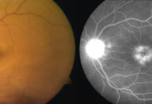 Treating uveitic macular edema : Delivery of corticosteroids directly into the eye is more effective than injections adjacent to the eye