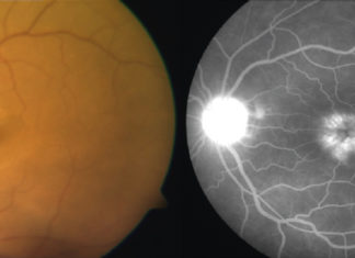 Treating uveitic macular edema : Delivery of corticosteroids directly into the eye is more effective than injections adjacent to the eye