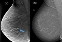 3-D mammography detected 34% more breast cancers in screening