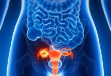 A drug (Lynparza) could help slow the progression of some advanced ovarian cancers and extend the time that patients show no signs of disease