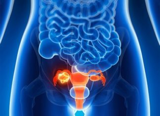 A drug (Lynparza) could help slow the progression of some advanced ovarian cancers and extend the time that patients show no signs of disease
