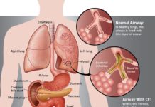 A new triple-combination drug treatment being trialled at the Mater Hospital in Brisbane could increase the life expectancy of patients with cystic fibrosis