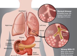 A new triple-combination drug treatment being trialled at the Mater Hospital in Brisbane could increase the life expectancy of patients with cystic fibrosis