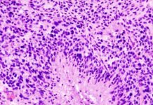 A specific protein called TEAD1 is an important regulator of tumor migration in glioblastoma