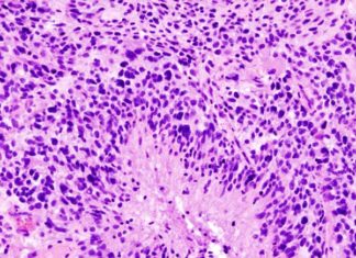 A specific protein called TEAD1 is an important regulator of tumor migration in glioblastoma