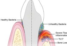 An unhealthy population of microbes in the mouth triggers specialized immune cells that inflame and destroy tissues